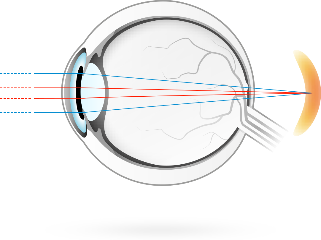 Verziendheid – aandoening waarbij visuele beelden scherp worden achter het netvlies, waardoor het voor de ogen moeilijker wordt om scherp te stellen op nabije objecten