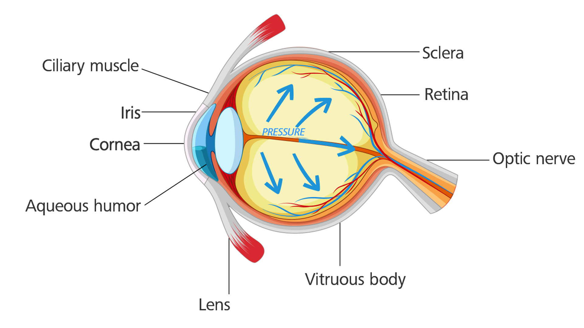 Oog met glaucoom: Oogdruk bouwt op en beschadigt de oogzenuw.