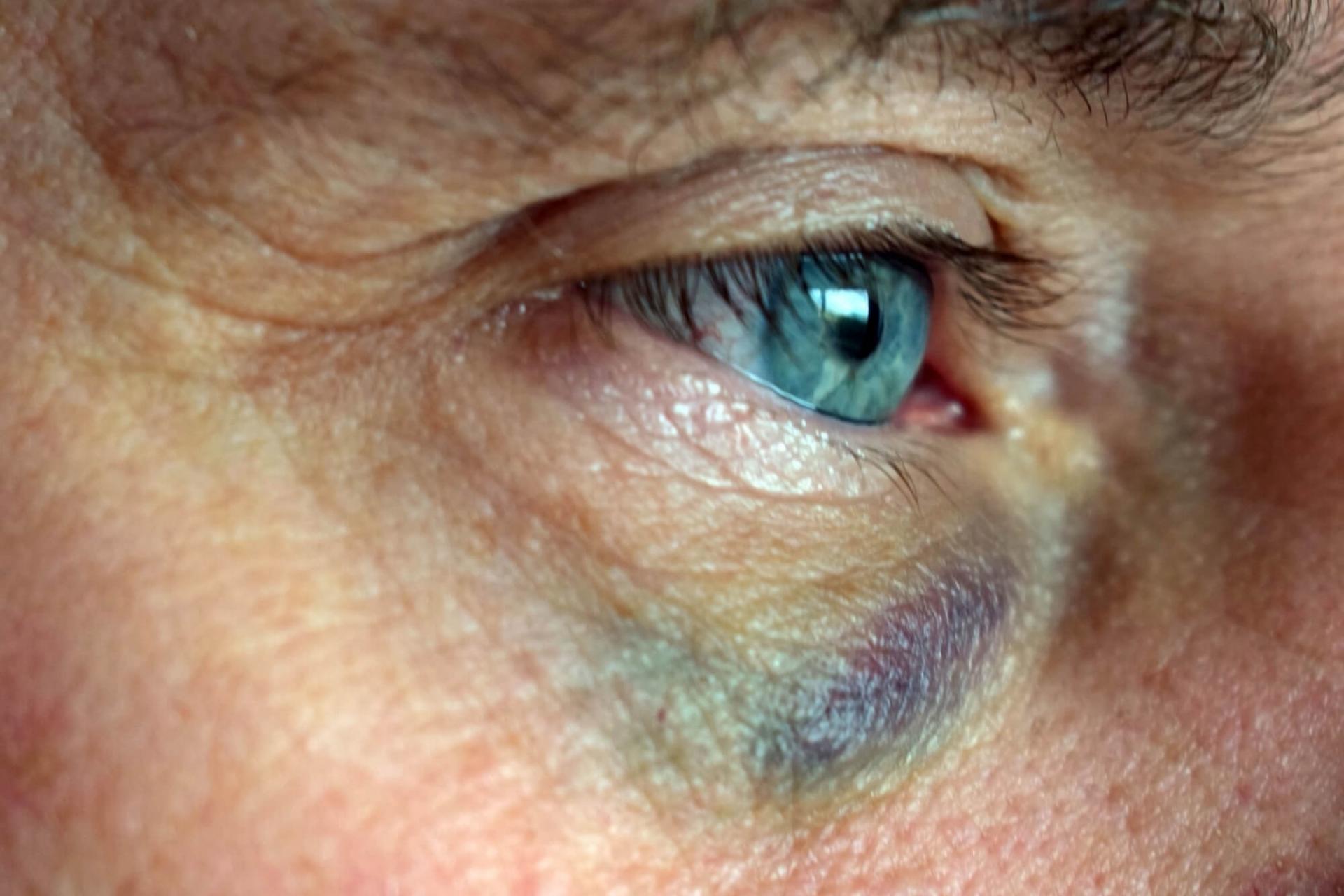 Blunt trauma can cause blood vessels in the eye to burst, and the white part of the eye (conjunctiva/sclera) will look red and bloodshot.