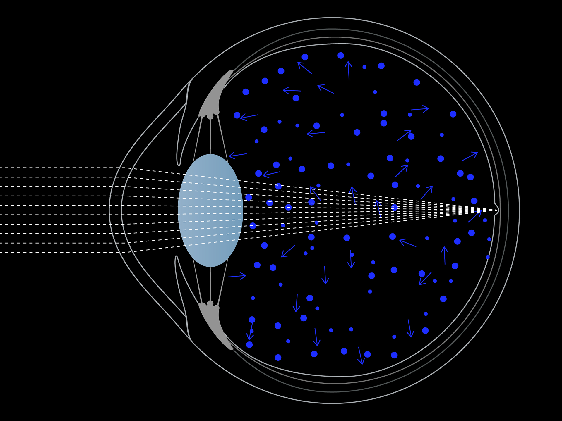 Schematische weergave van de verstrooiing van blauw licht in het oog.