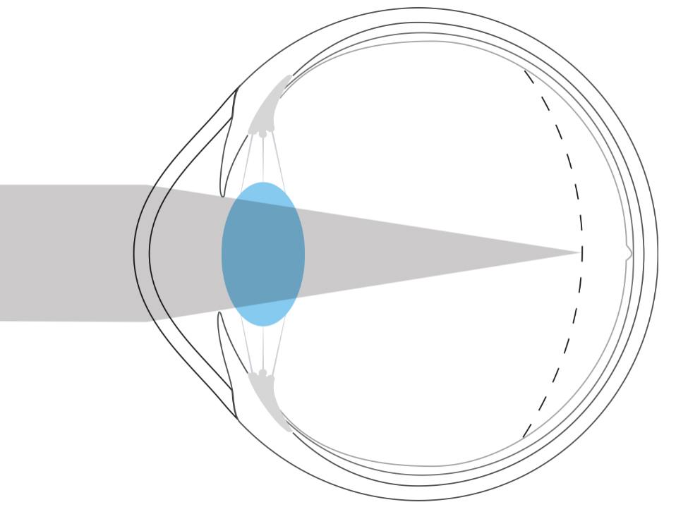 Illustratie van een bijziend oog die laat zien dat licht voor het netvlies wordt gefocust.